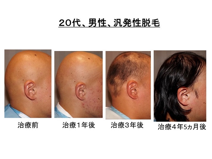 円形脱毛症　病院